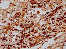 IHC image of CSB-PA010967LA01HU diluted at 1:1000 and staining in paraffin-embedded human breast cancer performed on a Leica BondTM system. After dewaxing and hydration, antigen retrieval was mediated by high pressure in a citrate buffer (pH 6.0). Section was blocked with 10% normal goat serum 30min at RT. Then primary antibody (1% BSA) was incubated at 4&deg;C overnight. The primary is detected by a biotinylated secondary antibody and visualized using an HRP conjugated SP system.