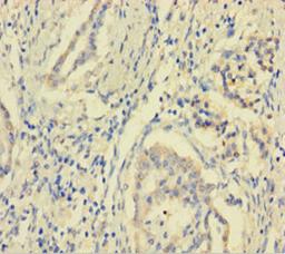 Immunohistochemistry of paraffin-embedded human pancreatic cancer using CSB-PA892143HA01HU at dilution of 1:100