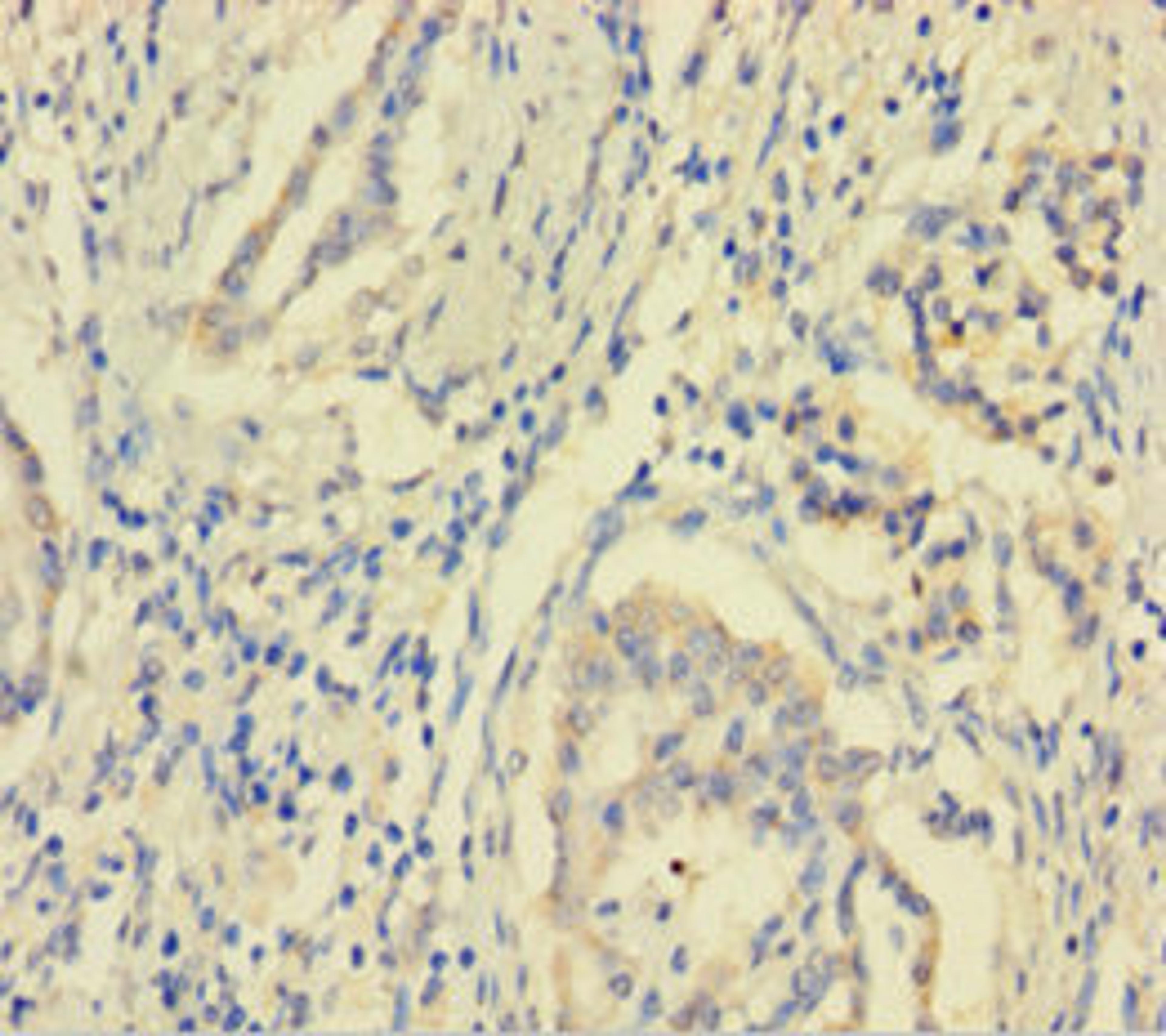 Immunohistochemistry of paraffin-embedded human pancreatic cancer using CSB-PA892143HA01HU at dilution of 1:100