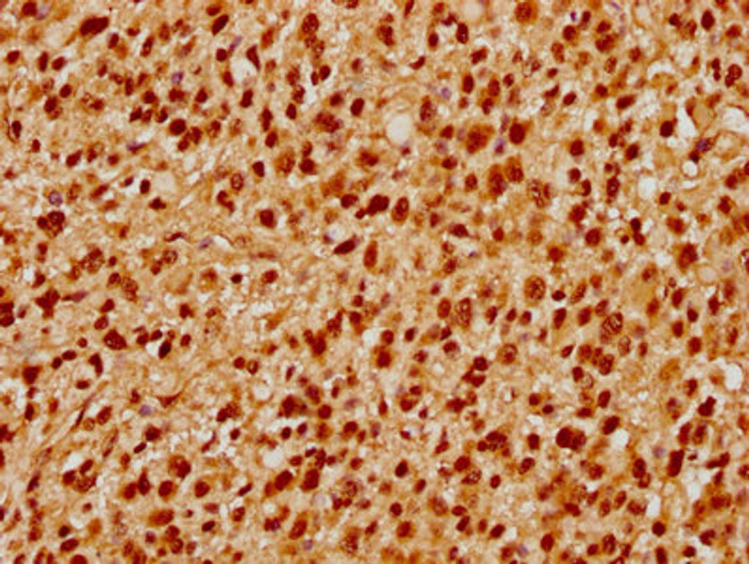 IHC image of CSB-PA769774LA01HU diluted at 1:500 and staining in paraffin-embedded human glioma performed on a Leica BondTM system. After dewaxing and hydration, antigen retrieval was mediated by high pressure in a citrate buffer (pH 6.0). Section was blocked with 10% normal goat serum 30min at RT. Then primary antibody (1% BSA) was incubated at 4°C overnight. The primary is detected by a biotinylated secondary antibody and visualized using an HRP conjugated SP system.