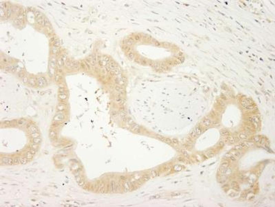 Immunohistochemistry-Paraffin: LARP1 Antibody [NBP1-19128] - Human colon carcinoma.  Antibody used at a dilution of 1:200.