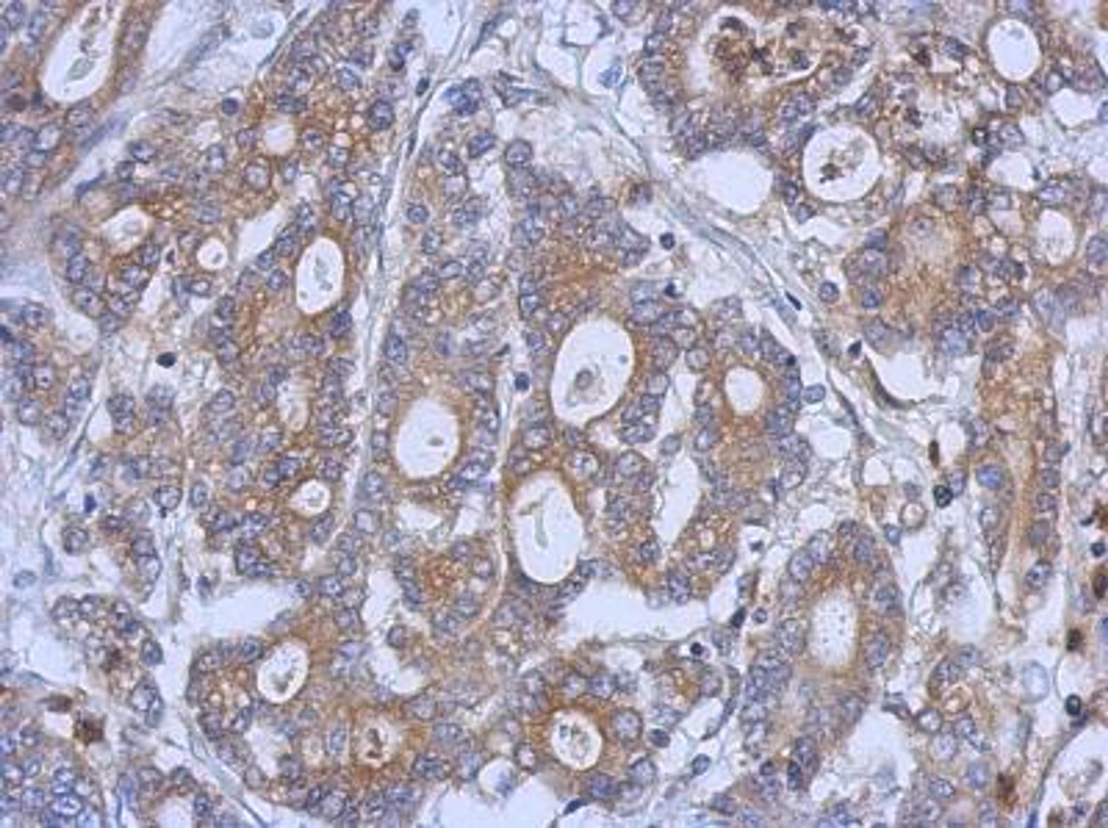 Immunohistochemistry-Paraffin: Glycogen phosphorylase, muscle form Antibody [NBP2-16689] - Immunohistochemical analysis of paraffin-embedded Gastric ca, using antibody at 1:500 dilution.