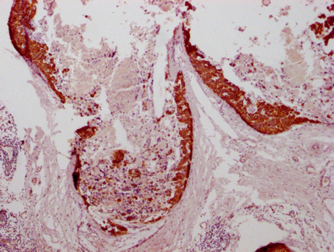 IHC image of CSB-MA634481 diluted at 1:100 and staining in paraffin-embedded human breast cancer performed on a Leica BondTM system. After dewaxing and hydration, antigen retrieval was mediated by high pressure in a citrate buffer (pH 6.0). Section was blocked with 10% normal goat serum 30min at RT. Then primary antibody (1% BSA) was incubated at 4°C overnight. The primary is detected by a Goat anti-mouse IgG polymer labeled by HRP and visualized using 0.05% DAB.