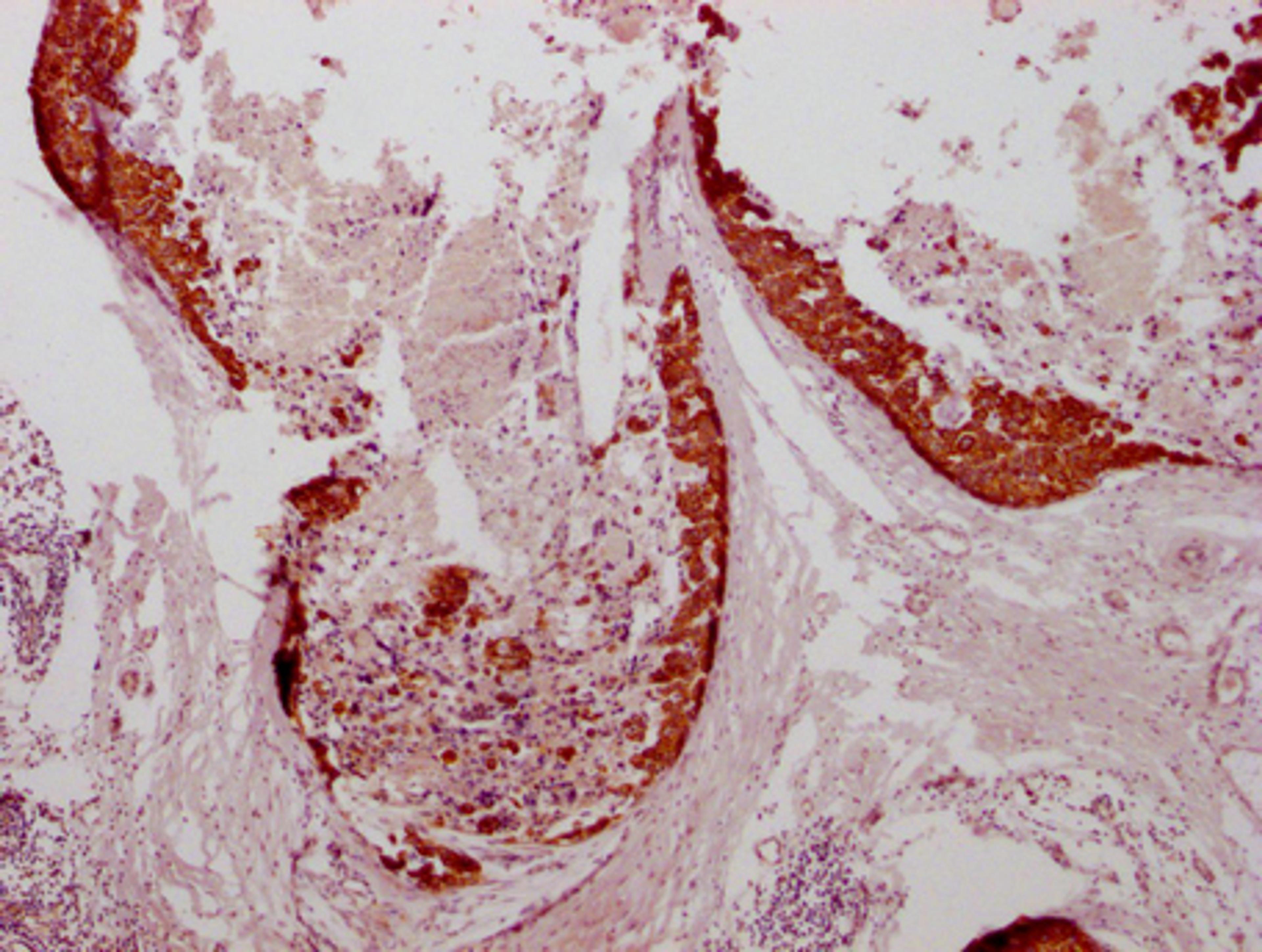 IHC image of CSB-MA634481 diluted at 1:100 and staining in paraffin-embedded human breast cancer performed on a Leica BondTM system. After dewaxing and hydration, antigen retrieval was mediated by high pressure in a citrate buffer (pH 6.0). Section was blocked with 10% normal goat serum 30min at RT. Then primary antibody (1% BSA) was incubated at 4°C overnight. The primary is detected by a Goat anti-mouse IgG polymer labeled by HRP and visualized using 0.05% DAB.