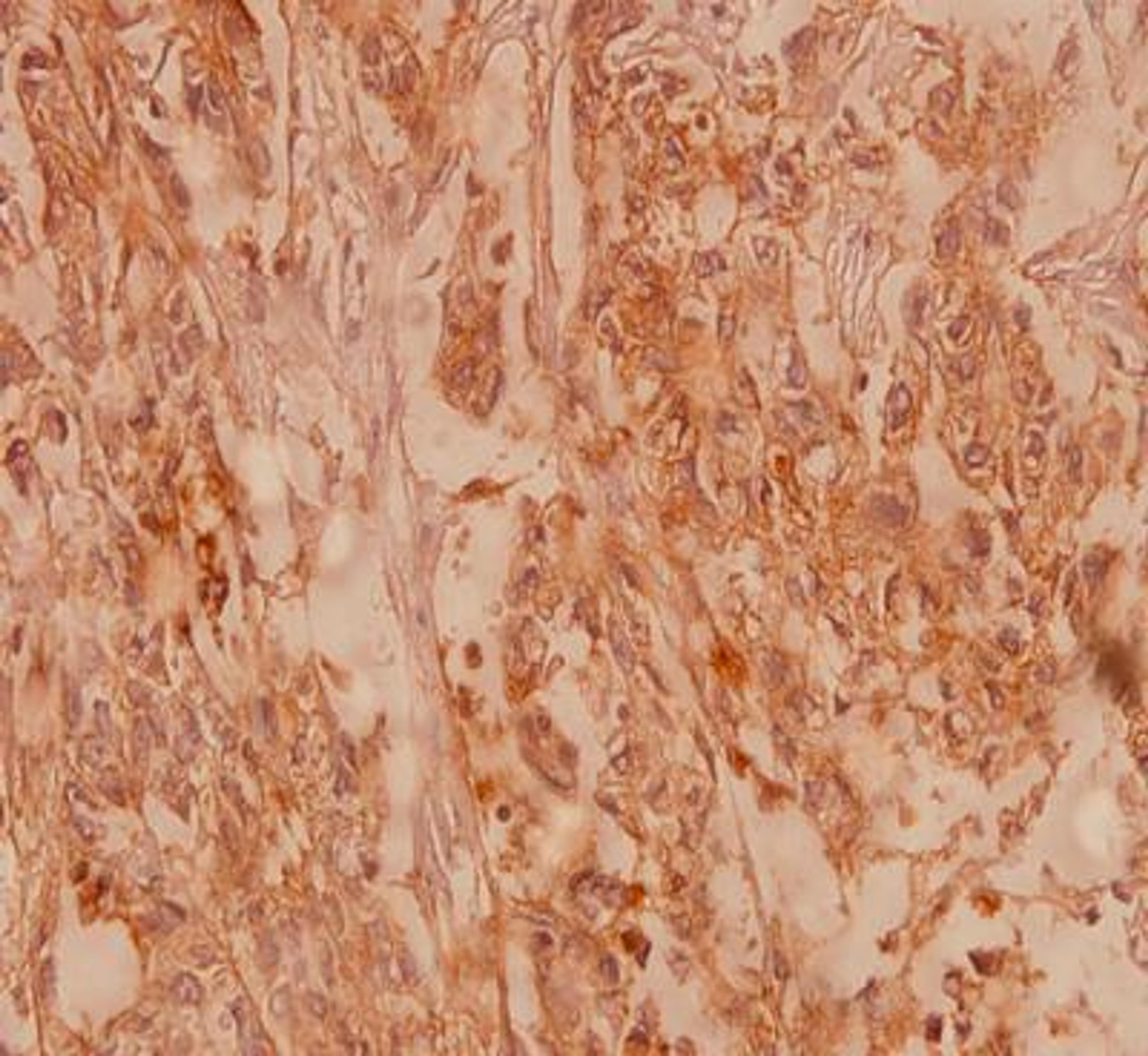 Immunohistochemistry-Paraffin: Claudin-4 Antibody [NB100-91712] - Human breast carcinoma tissue.