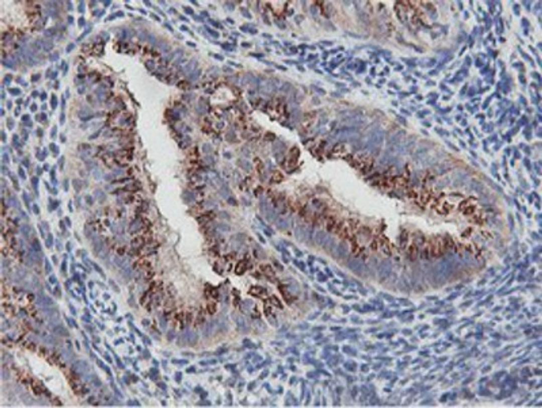 Immunohistochemistry-Paraffin: NMT2 Antibody (1G3) [NBP2-01676] - Staining of paraffin-embedded Adenocarcinoma of Human endometrium tissue using anti-NMT2 mouse monoclonal antibody.