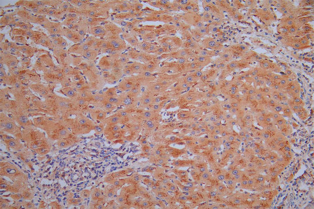 IHC image of CSB-RA006193MA1HU diluted at 1:30 and staining in paraffin-embedded human liver cancer performed on a Leica BondTM system. After dewaxing and hydration, antigen retrieval was mediated by high pressure in a citrate buffer (pH 6.0). Section was blocked with 10% normal goat serum 30min at RT. Then primary antibody (1% BSA) was incubated at 4°C overnight. The primary is detected by a Goat anti-Mouse IgG labeled by HRP and visualized using 0.05% DAB.