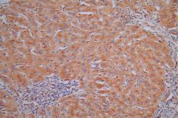 IHC image of CSB-RA006193MA1HU diluted at 1:30 and staining in paraffin-embedded human liver cancer performed on a Leica BondTM system. After dewaxing and hydration, antigen retrieval was mediated by high pressure in a citrate buffer (pH 6.0). Section was blocked with 10% normal goat serum 30min at RT. Then primary antibody (1% BSA) was incubated at 4°C overnight. The primary is detected by a Goat anti-Mouse IgG labeled by HRP and visualized using 0.05% DAB.