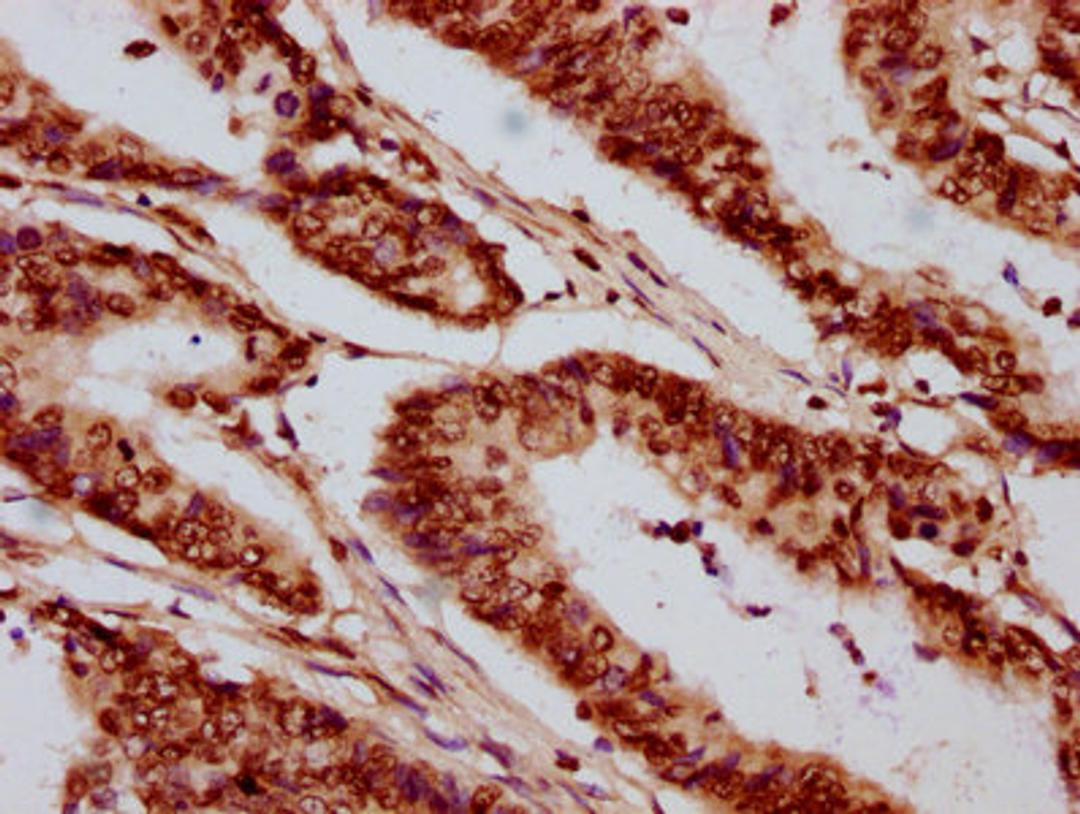 IHC image of CSB-PA010389OA05nbutHU diluted at 1:20 and staining in paraffin-embedded human colon cancer performed on a Leica BondTM system. After dewaxing and hydration, antigen retrieval was mediated by high pressure in a citrate buffer (pH 6.0). Section was blocked with 10% normal goat serum 30min at RT. Then primary antibody (1% BSA) was incubated at 4°C overnight. The primary is detected by a biotinylated secondary antibody and visualized using an HRP conjugated SP system.