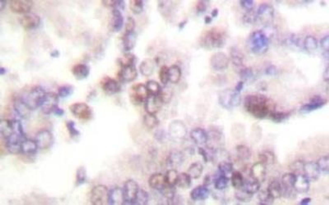 Immunohistochemistry: p15INK4b/CDKN2B Antibody [NB100-91906] - p15 INK (G113) antibody in paraffin-embedded human lung  carcinoma tissue