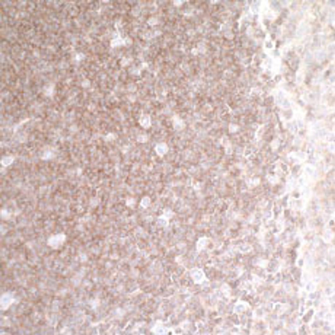 Detection of human HVEM/TNFRSF14 in FFPE lung carcinoma by IHC.