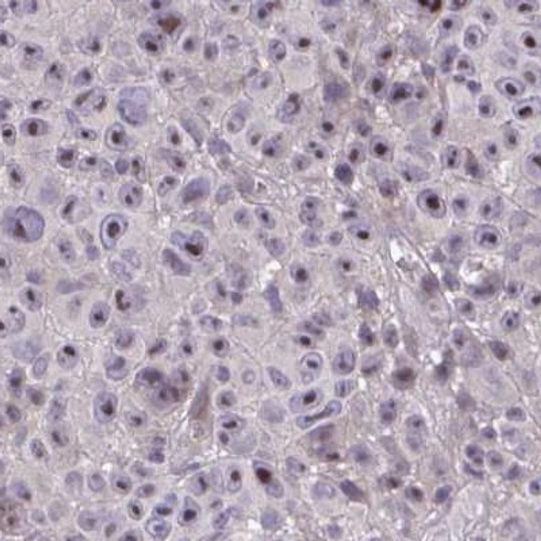 Immunohistochemistry: HMBOX1 Antibody [NBP2-32392] - melanoma