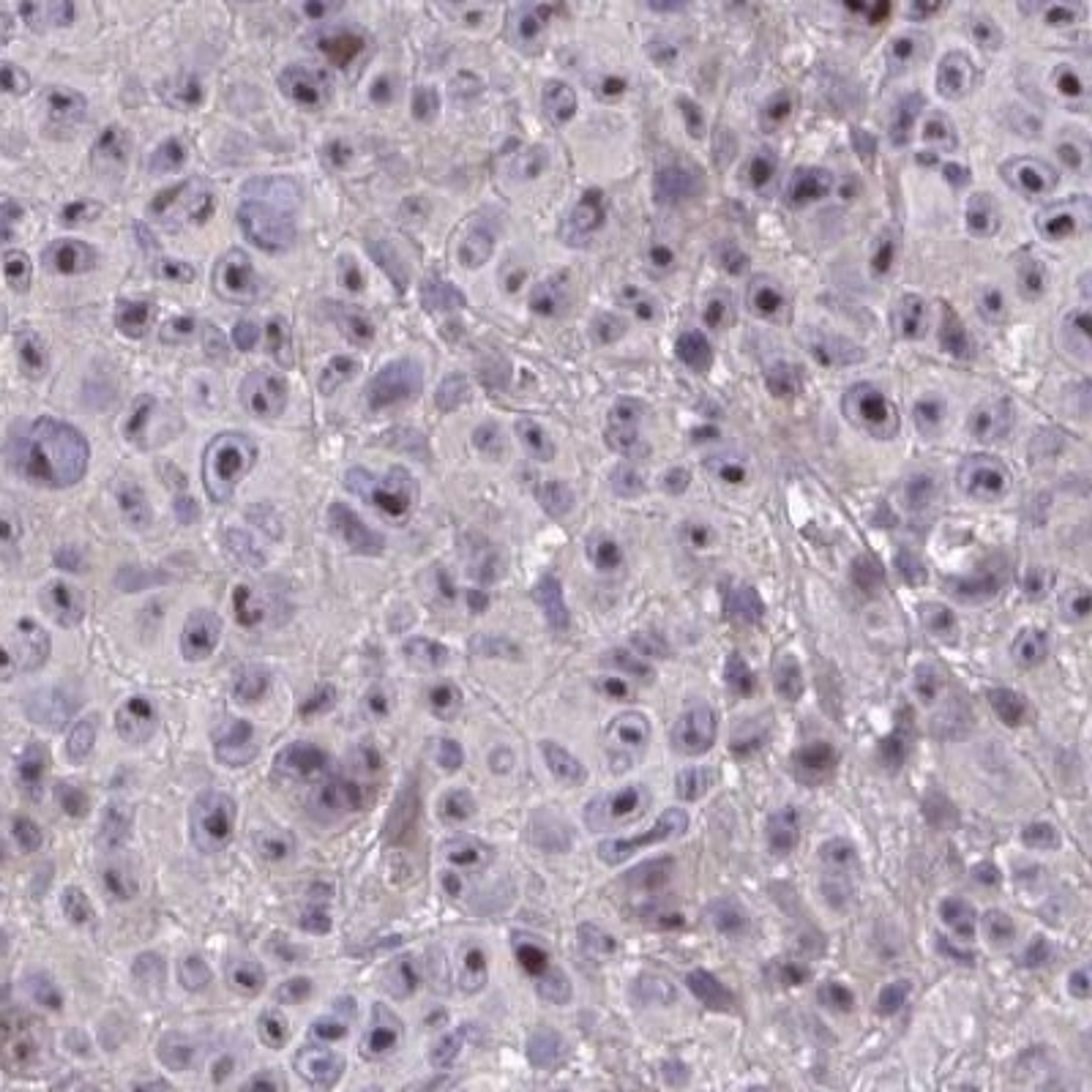 Immunohistochemistry: HMBOX1 Antibody [NBP2-32392] - melanoma