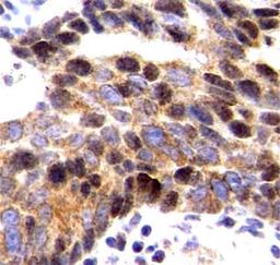 Immunohistochemistry-Paraffin: CXCL12 alpha/SDF1 alpha Antibody [NBP2-29480] -  Formalin fixed paraffin embedded tissue section of human colorectal carcinoma stained using SDF-1 alpha antibody (NBP2-29480) with DAB detection. Sodium citrate buffer (pH6.0) based heat mediated antigen retrieval was employed  in this IHC-P validation.