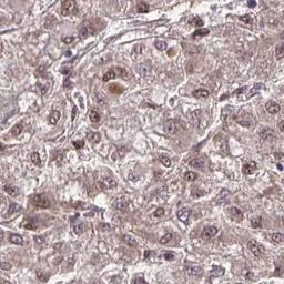 Immunohistochemistry: ZNF193 Antibody [NBP2-31579] - liver cancer