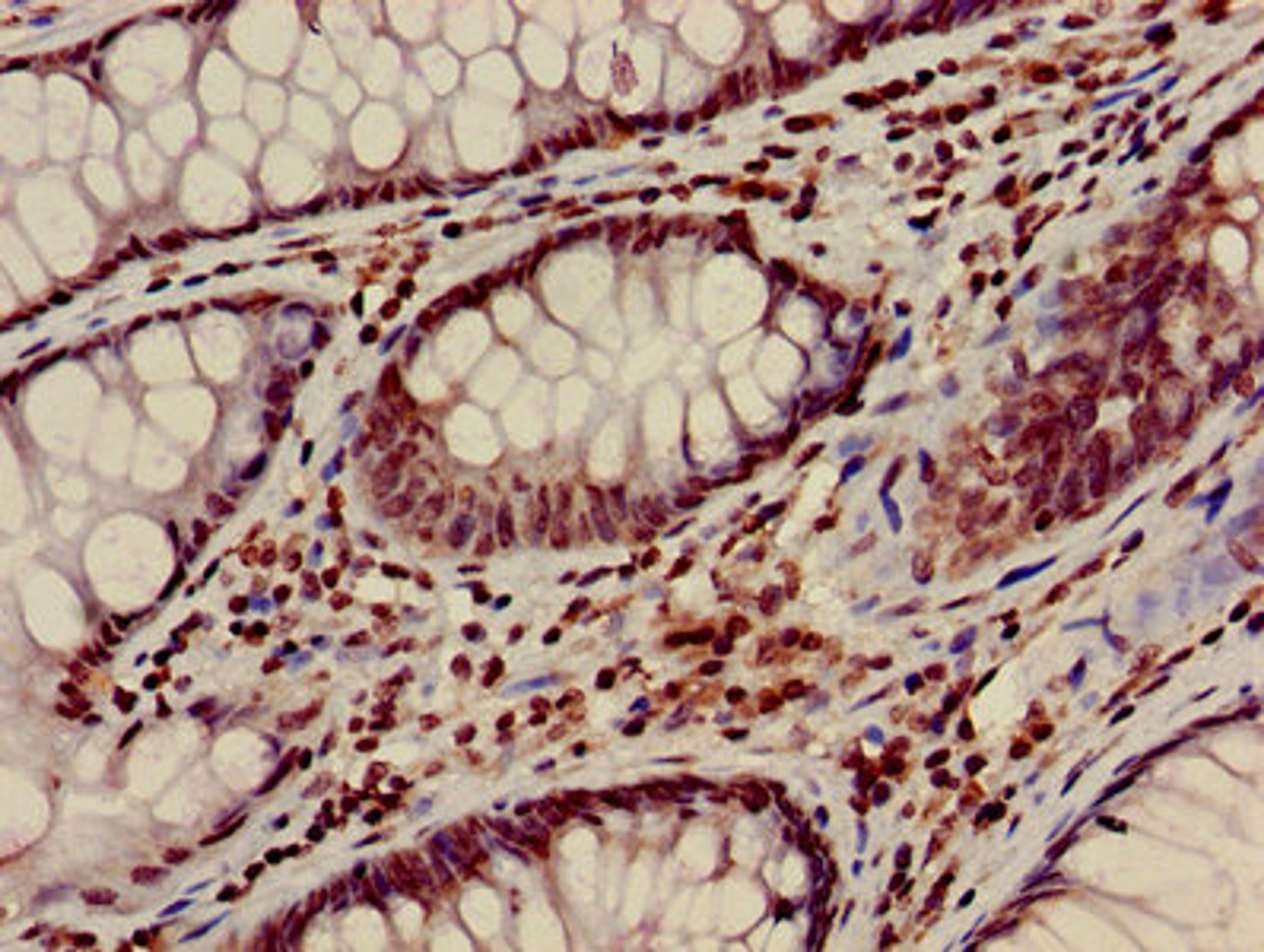 Immunohistochemistry of paraffin-embedded human colon cancer using CSB-PA010418PA28nacHU at dilution of 1:100