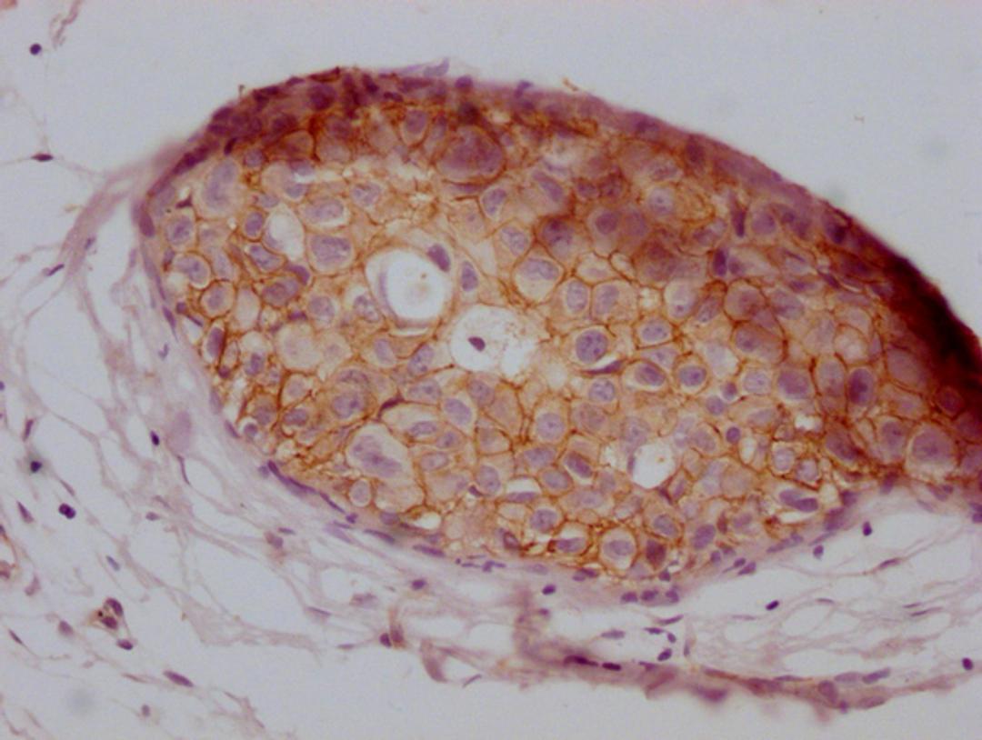 IHC image of CSB-MA907551 diluted at 1:100 and staining in paraffin-embedded human breast cancer performed on a Leica BondTM system. After dewaxing and hydration, antigen retrieval was mediated by high pressure in a citrate buffer (pH 6.0). Section was blocked with 10% normal goat serum 30min at RT. Then primary antibody (1% BSA) was incubated at 4°C overnight. The primary is detected by a Goat anti-mouse IgG polymer labeled by HRP and visualized using 0.05% DAB.