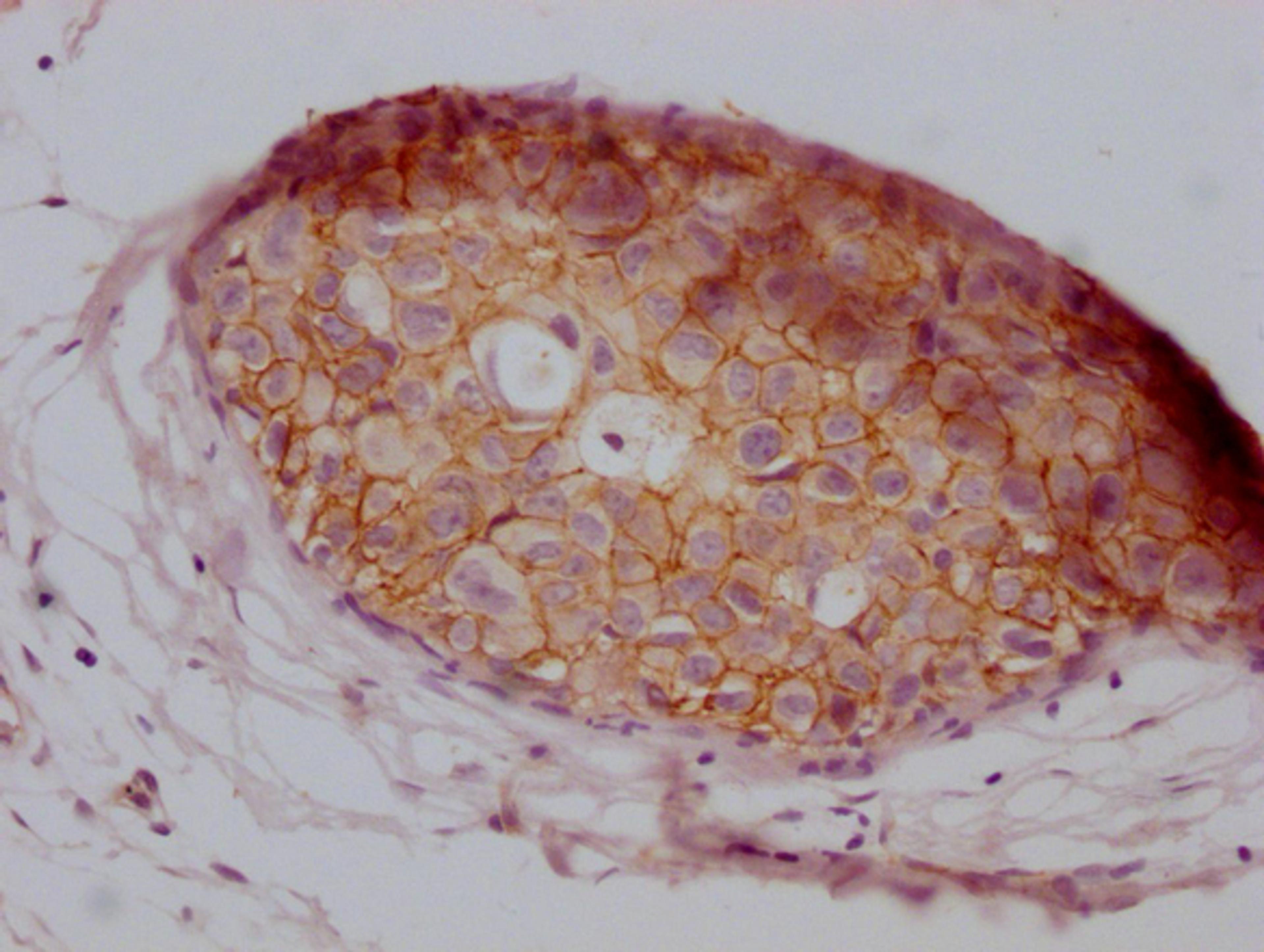 IHC image of CSB-MA907551 diluted at 1:100 and staining in paraffin-embedded human breast cancer performed on a Leica BondTM system. After dewaxing and hydration, antigen retrieval was mediated by high pressure in a citrate buffer (pH 6.0). Section was blocked with 10% normal goat serum 30min at RT. Then primary antibody (1% BSA) was incubated at 4°C overnight. The primary is detected by a Goat anti-mouse IgG polymer labeled by HRP and visualized using 0.05% DAB.