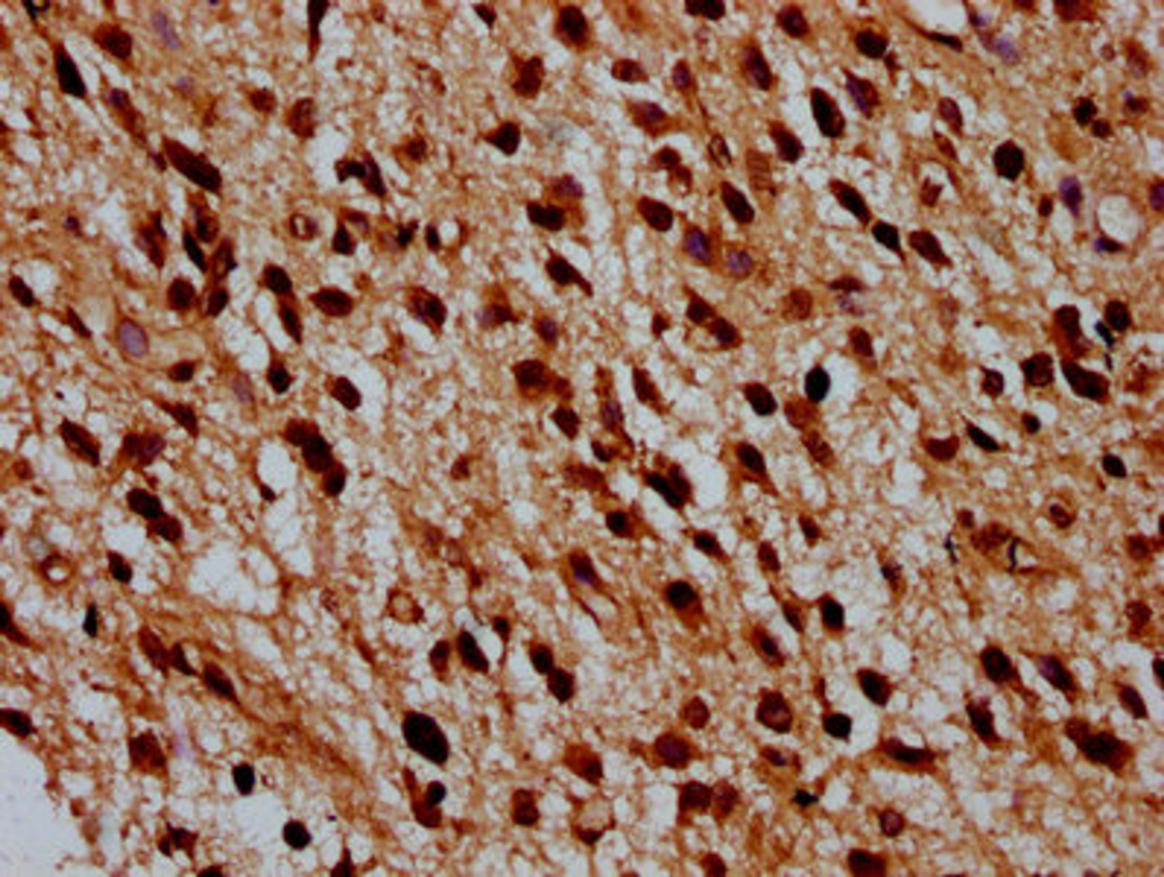 IHC image of CSB-PA010429OA12nbutHU diluted at 1:100 and staining in paraffin-embedded human glioma performed on a Leica BondTM system. After dewaxing and hydration, antigen retrieval was mediated by high pressure in a citrate buffer (pH 6.0). Section was blocked with 10% normal goat serum 30min at RT. Then primary antibody (1% BSA) was incubated at 4°C overnight. The primary is detected by a biotinylated secondary antibody and visualized using an HRP conjugated SP system.