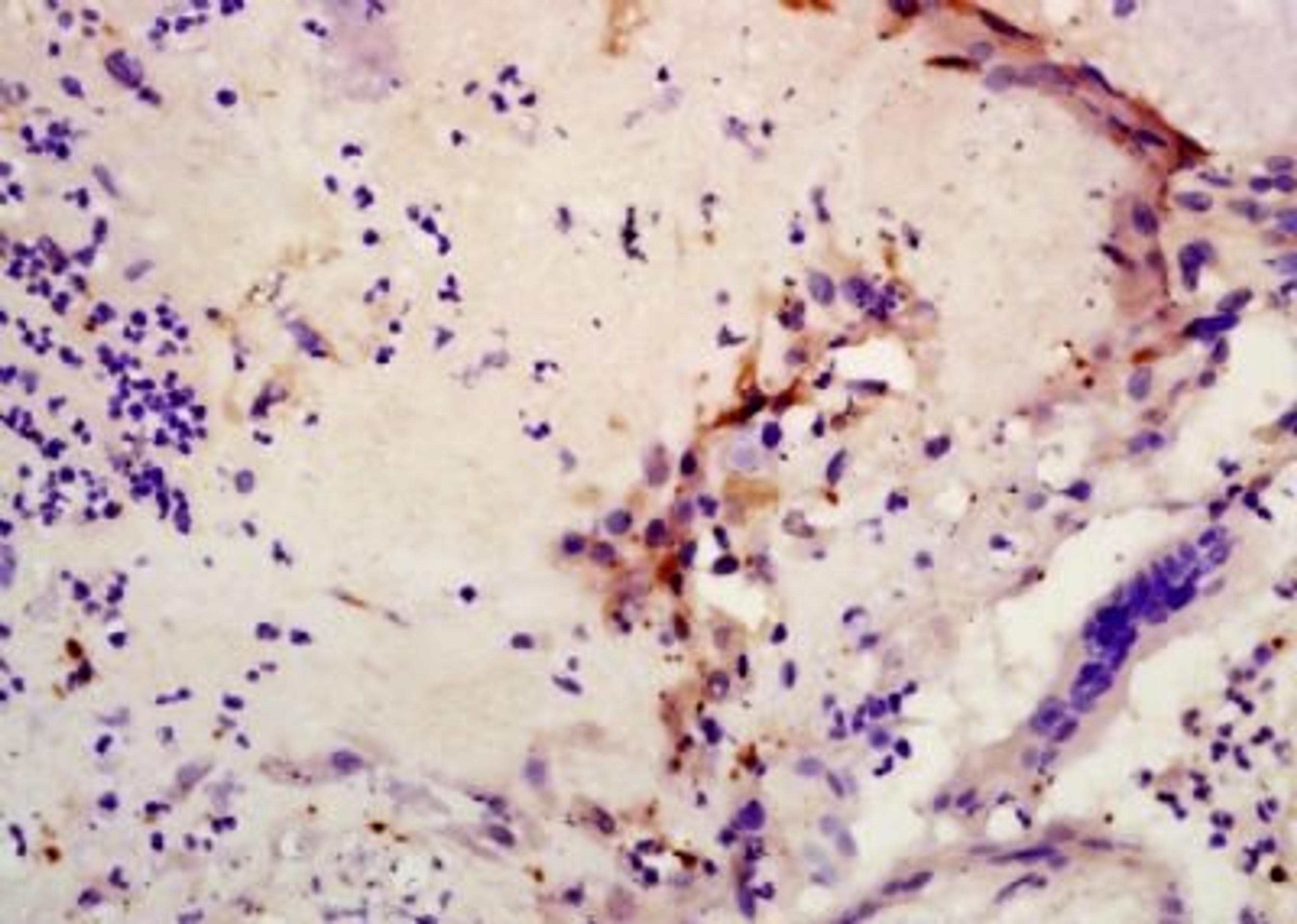 Immunohistochemical analysis of formalin-fixed paraffin embedded human gastric adenocarcinoma tissue using CXCL6 antibody (dilution at 1:200)