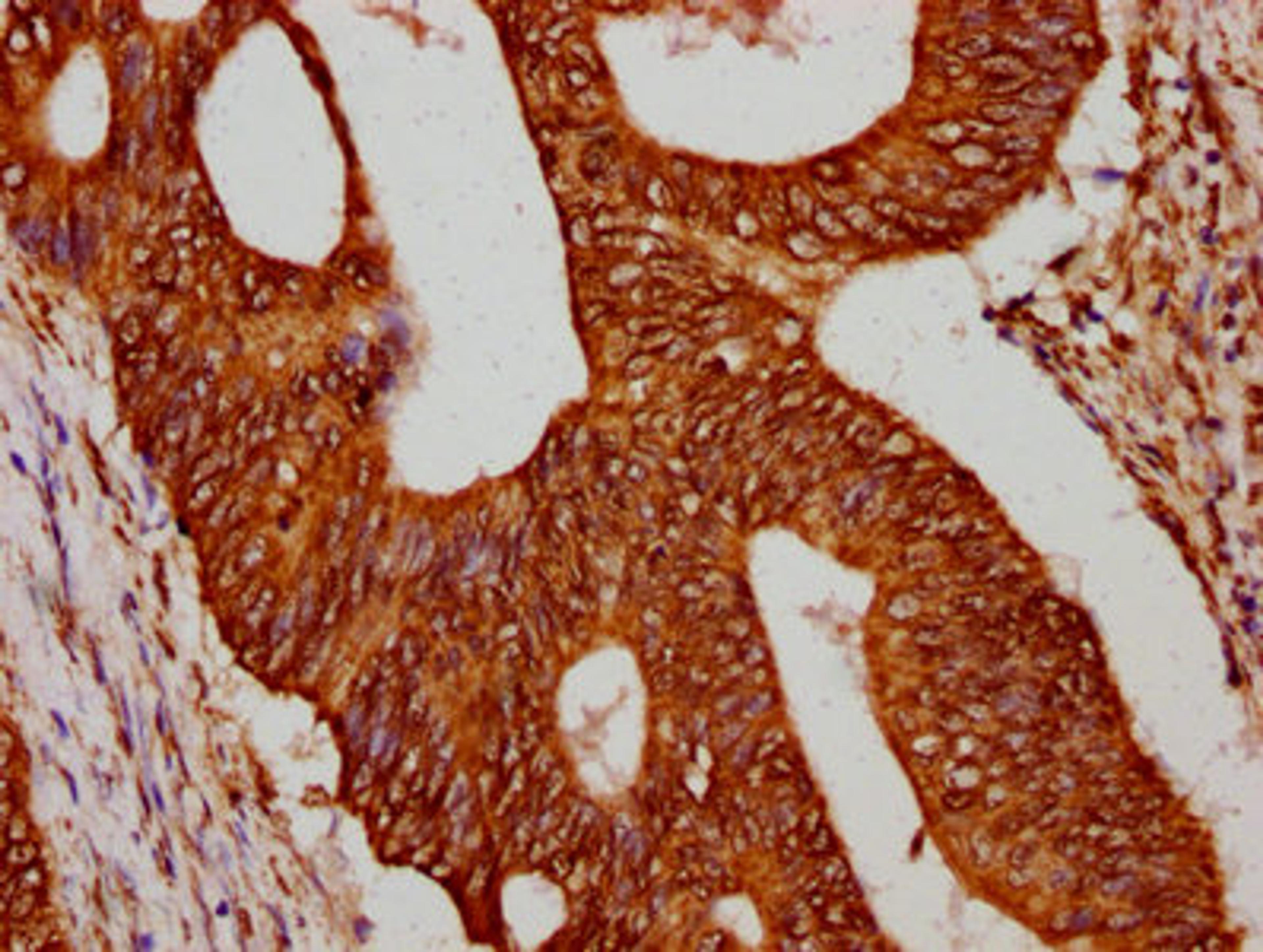 IHC image of CSB-PA010429OA12npropHU diluted at 1:75 and staining in paraffin-embedded human colon cancer performed on a Leica BondTM system. After dewaxing and hydration, antigen retrieval was mediated by high pressure in a citrate buffer (pH 6.0). Section was blocked with 10% normal goat serum 30min at RT. Then primary antibody (1% BSA) was incubated at 4&deg;C overnight. The primary is detected by a biotinylated secondary antibody and visualized using an HRP conjugated SP system.
