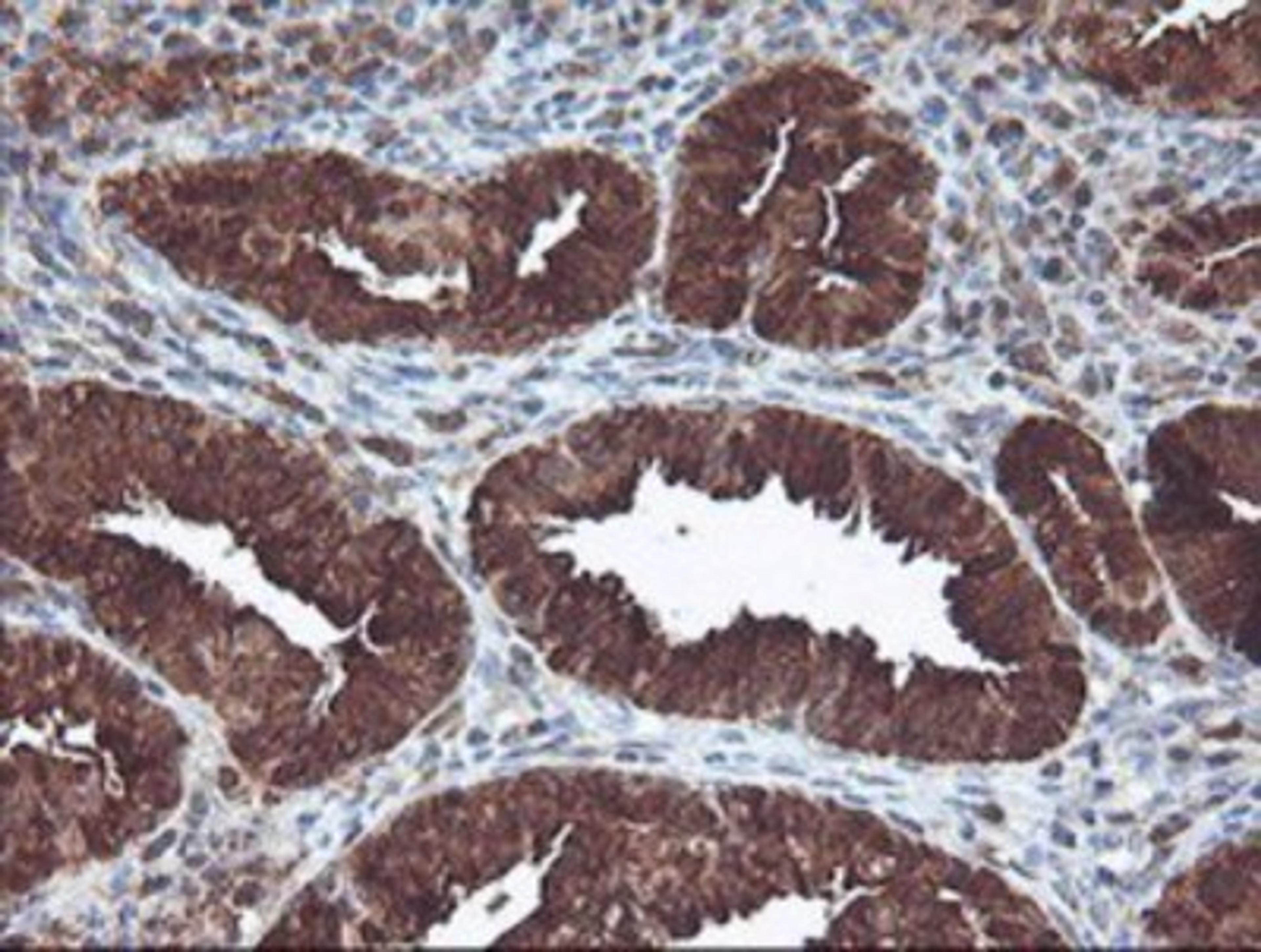 Immunohistochemistry-Paraffin: CNDP2 Antibody (8A2) [NBP2-00953] - Staining of paraffin-embedded Adenocarcinoma of Human endometrium tissue using anti-CNDP2 mouse monoclonal antibody.