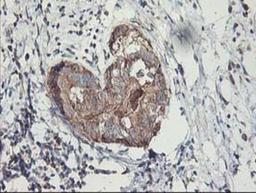 Immunohistochemistry-Paraffin: MTFMT Antibody (1E7) [NBP2-01232] - Staining of paraffin-embedded Adenocarcinoma of Human breast tissue using anti-MTFMT mouse monoclonal antibody.