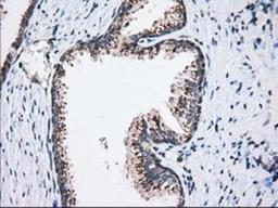 Immunohistochemistry-Paraffin: MOB4A Antibody (3G9) [NBP2-02715] - Staining of paraffin-embedded Carcinoma of Human prostate tissue using anti-MOB4A mouse monoclonal antibody.