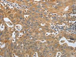 The image on the left is immunohistochemistry of paraffin-embedded Human ovarian cancer tissue using CSB-PA796280(AMPH Antibody) at dilution 1/30, on the right is treated with fusion protein. (Original magnification: ×200)