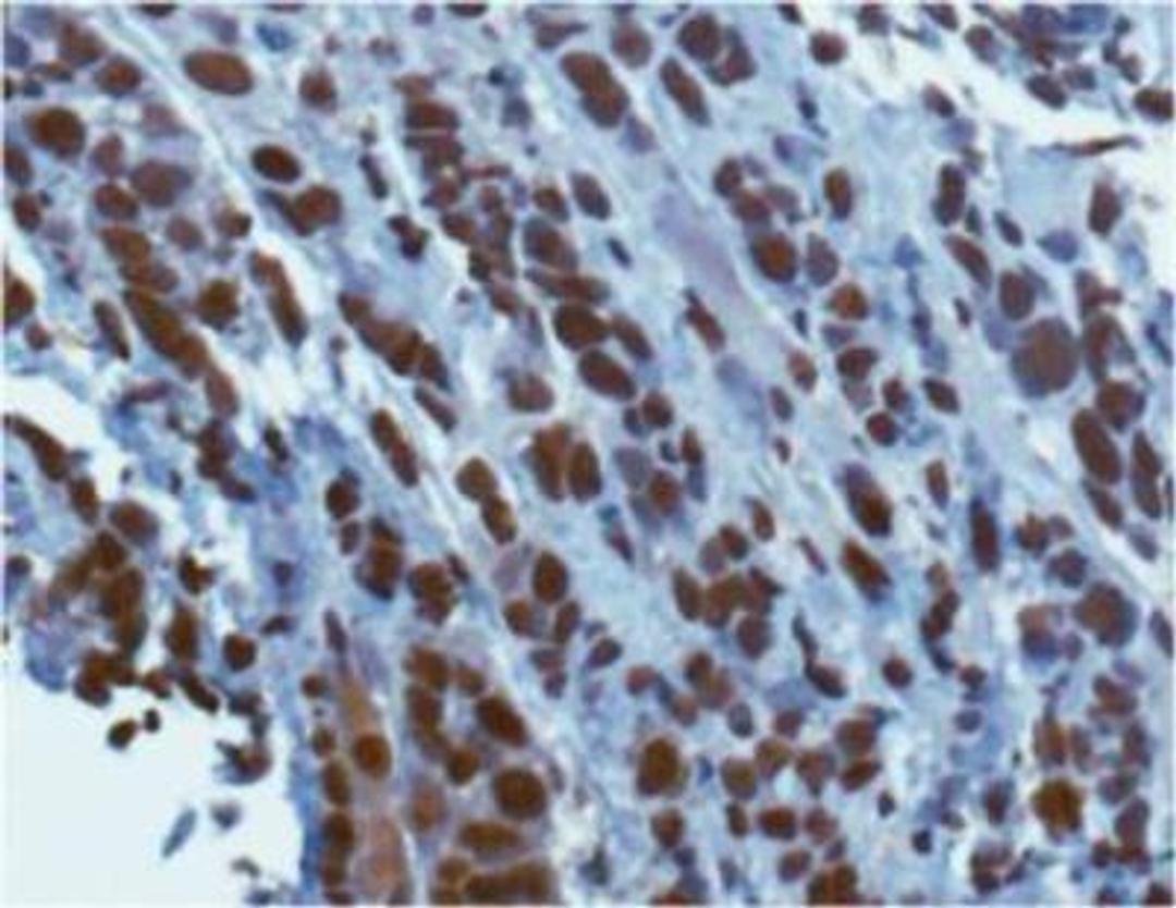 Immunohistochemistry: KMT1A/SUV39H1 Antibody [NBP1-21367] - IHC analysis of KMT1A/SUV39H1 in human breast cancer using DAB with hematoxylin counterstain.