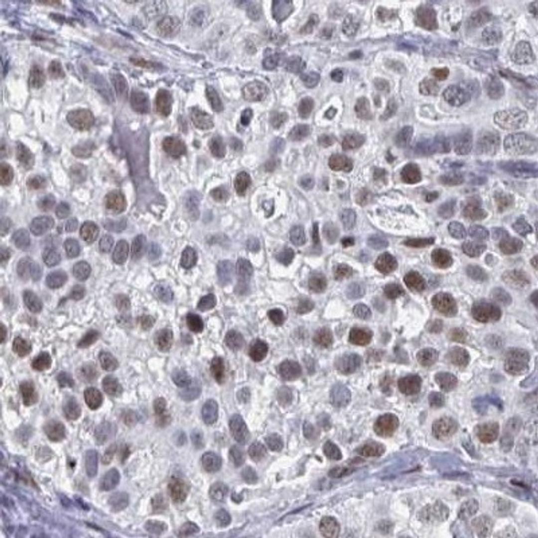 Immunohistochemistry: C15orf41 Antibody [NBP2-32583] - liver cancer