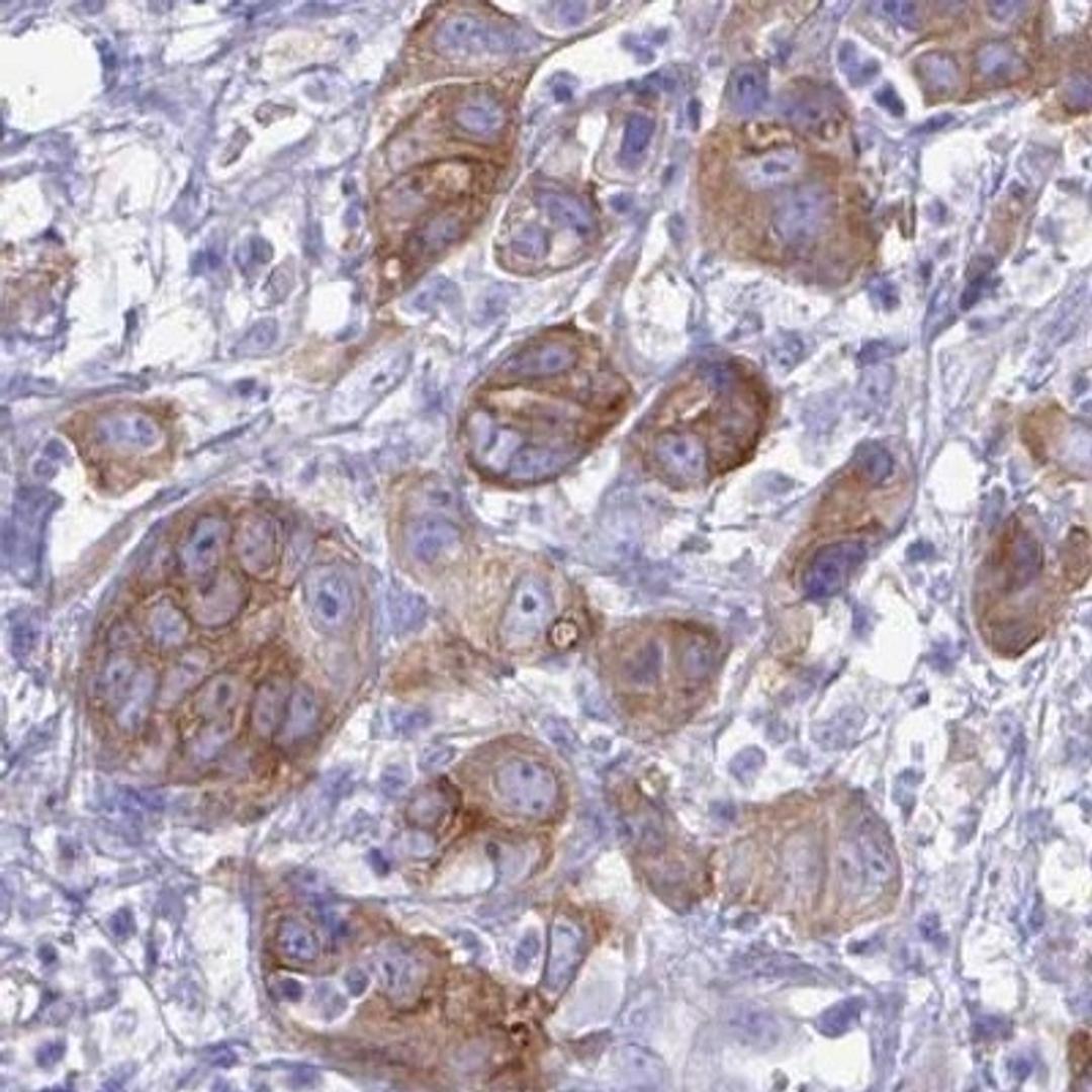 Immunohistochemistry: KIAA0284 Antibody [NBP2-31739] - pancreatic cancer