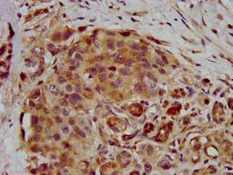 IHC image of CSB-PA019888LA01HU diluted at 1:400 and staining in paraffin-embedded human pancreatic cancer performed on a Leica BondTM system. After dewaxing and hydration, antigen retrieval was mediated by high pressure in a citrate buffer (pH 6.0). Section was blocked with 10% normal goat serum 30min at RT. Then primary antibody (1% BSA) was incubated at 4&deg;C overnight. The primary is detected by a biotinylated secondary antibody and visualized using an HRP conjugated SP system.