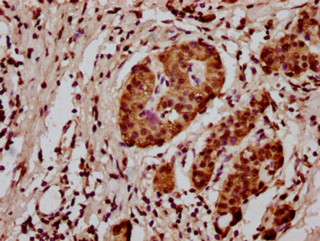 IHC image of CSB-PA010418OA128nme1HU diluted at 1:20 and staining in paraffin-embedded human pancreatic cancer performed on a Leica BondTM system. After dewaxing and hydration, antigen retrieval was mediated by high pressure in a citrate buffer (pH 6.0). Section was blocked with 10% normal goat serum 30min at RT. Then primary antibody (1% BSA) was incubated at 4°C overnight. The primary is detected by a biotinylated secondary antibody and visualized using an HRP conjugated SP system.