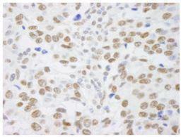 Immunohistochemistry-Paraffin: SAFB Antibody [NB100-2593] - FFPE section of human breast adenocarcinoma.  Affinity purified rabbit anti-SAFB1 used at a dilution of 1:250.