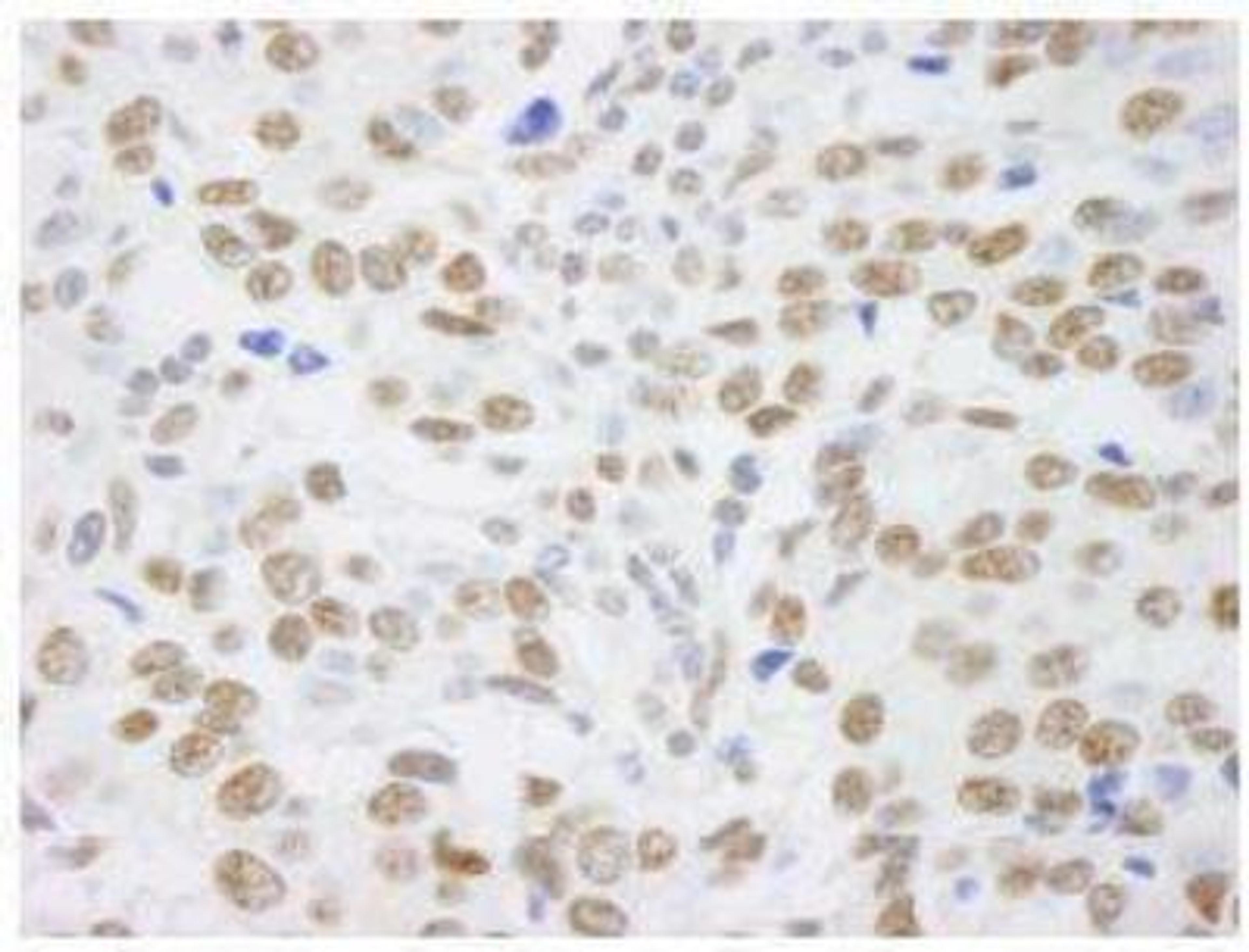 Immunohistochemistry-Paraffin: SAFB Antibody [NB100-2593] - FFPE section of human breast adenocarcinoma.  Affinity purified rabbit anti-SAFB1 used at a dilution of 1:250.