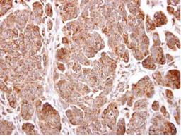 Immunohistochemistry-Paraffin: Transmembrane protein 59 Antibody [NBP1-32303] - Human ovarian carcinoma.