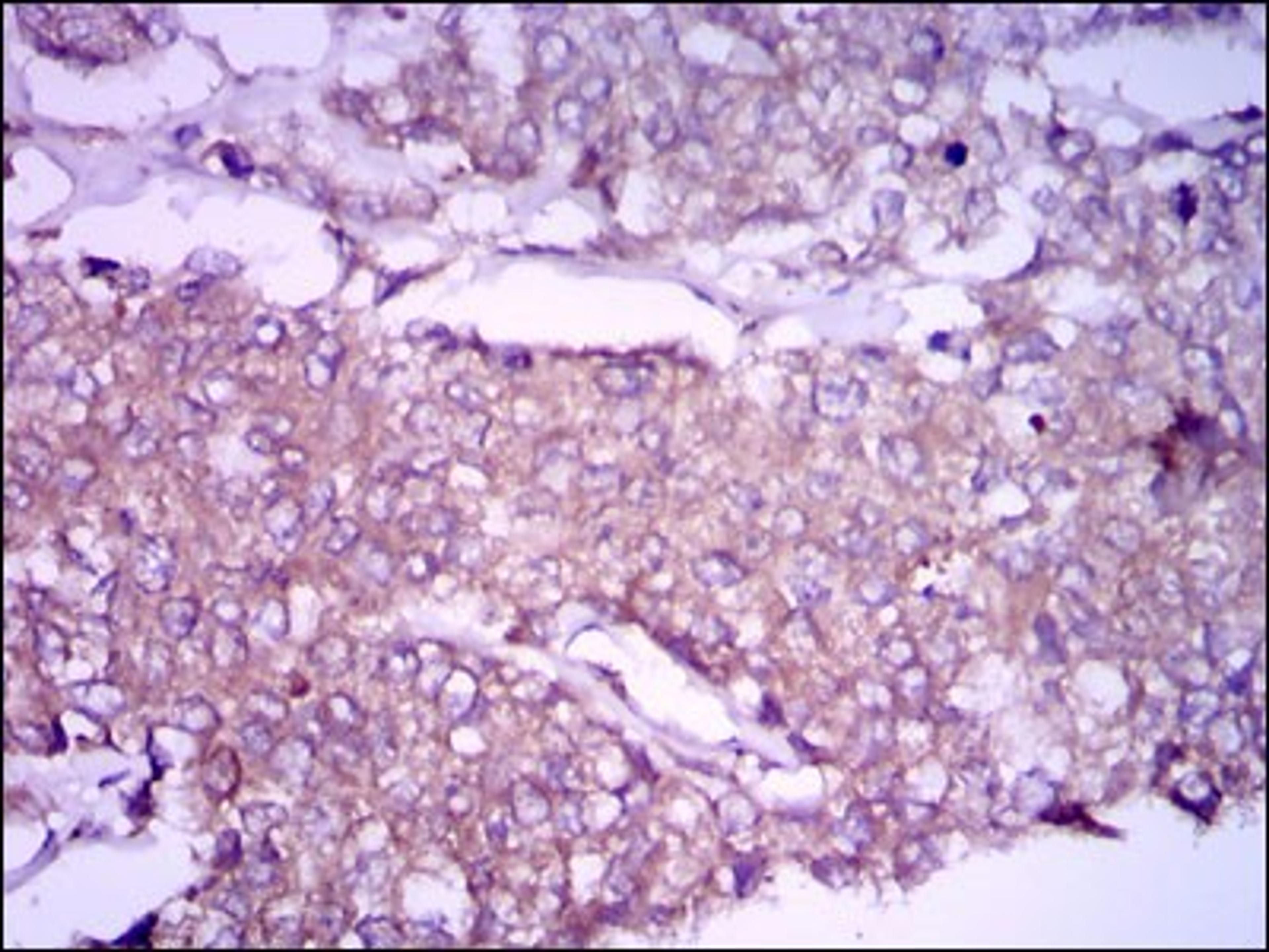 Immunohistochemistry: Glypican 3 Antibody (9C2) [NBP2-37483] - Immunohistochemical analysis of paraffin-embedded breast cancer tissues using GPC3 mouse mAb with DAB staining.