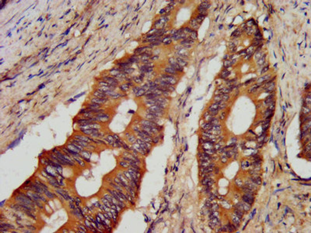 IHC image of CSB-PA872553LA01HU diluted at 1:300 and staining in paraffin-embedded human colon cancer performed on a Leica BondTM system.