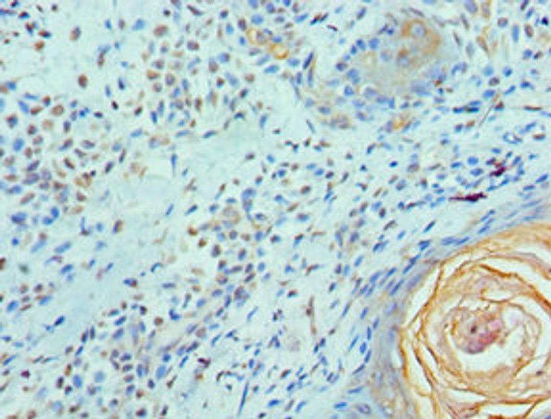 Immunohistochemistry of paraffin-embedded human breast cancer using CSB-PA857453ESR2HU at dilution of 1:100
