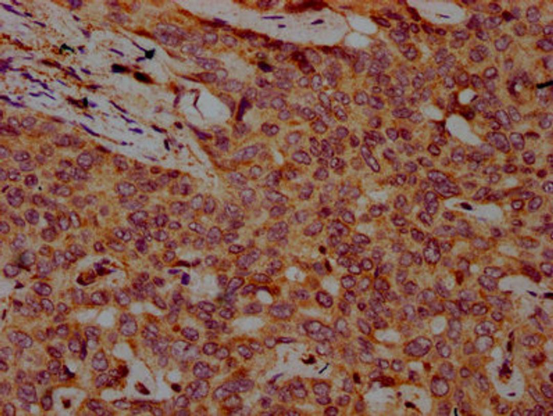 IHC image of CSB-PA890915LA01HU diluted at 1:500 and staining in paraffin-embedded human liver cancer performed on a Leica BondTM system. After dewaxing and hydration, antigen retrieval was mediated by high pressure in a citrate buffer (pH 6.0). Section was blocked with 10% normal goat serum 30min at RT. Then primary antibody (1% BSA) was incubated at 4°C overnight. The primary is detected by a biotinylated secondary antibody and visualized using an HRP conjugated SP system.