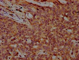 IHC image of CSB-PA890915LA01HU diluted at 1:500 and staining in paraffin-embedded human liver cancer performed on a Leica BondTM system. After dewaxing and hydration, antigen retrieval was mediated by high pressure in a citrate buffer (pH 6.0). Section was blocked with 10% normal goat serum 30min at RT. Then primary antibody (1% BSA) was incubated at 4°C overnight. The primary is detected by a biotinylated secondary antibody and visualized using an HRP conjugated SP system.