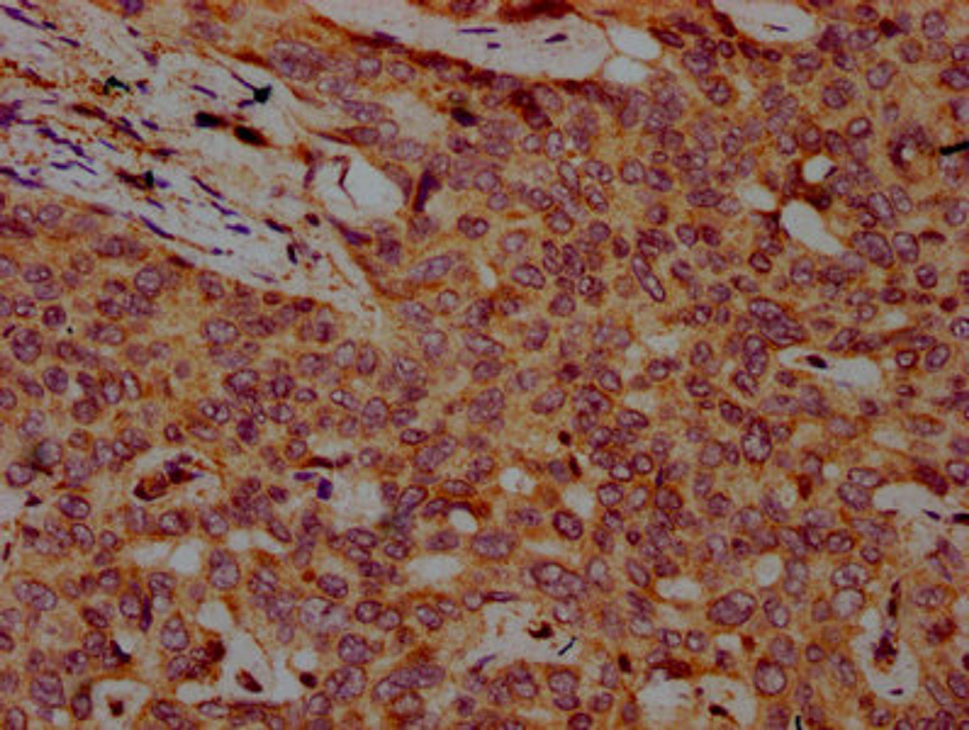 IHC image of CSB-PA890915LA01HU diluted at 1:500 and staining in paraffin-embedded human liver cancer performed on a Leica BondTM system. After dewaxing and hydration, antigen retrieval was mediated by high pressure in a citrate buffer (pH 6.0). Section was blocked with 10% normal goat serum 30min at RT. Then primary antibody (1% BSA) was incubated at 4°C overnight. The primary is detected by a biotinylated secondary antibody and visualized using an HRP conjugated SP system.