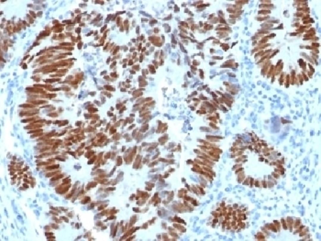 IHC testing of FFPE human colon carcinoma with p53 antibody. Required HIER: boil tissue sections in 10mM citrate buffer, pH 6, for 10-20 min.