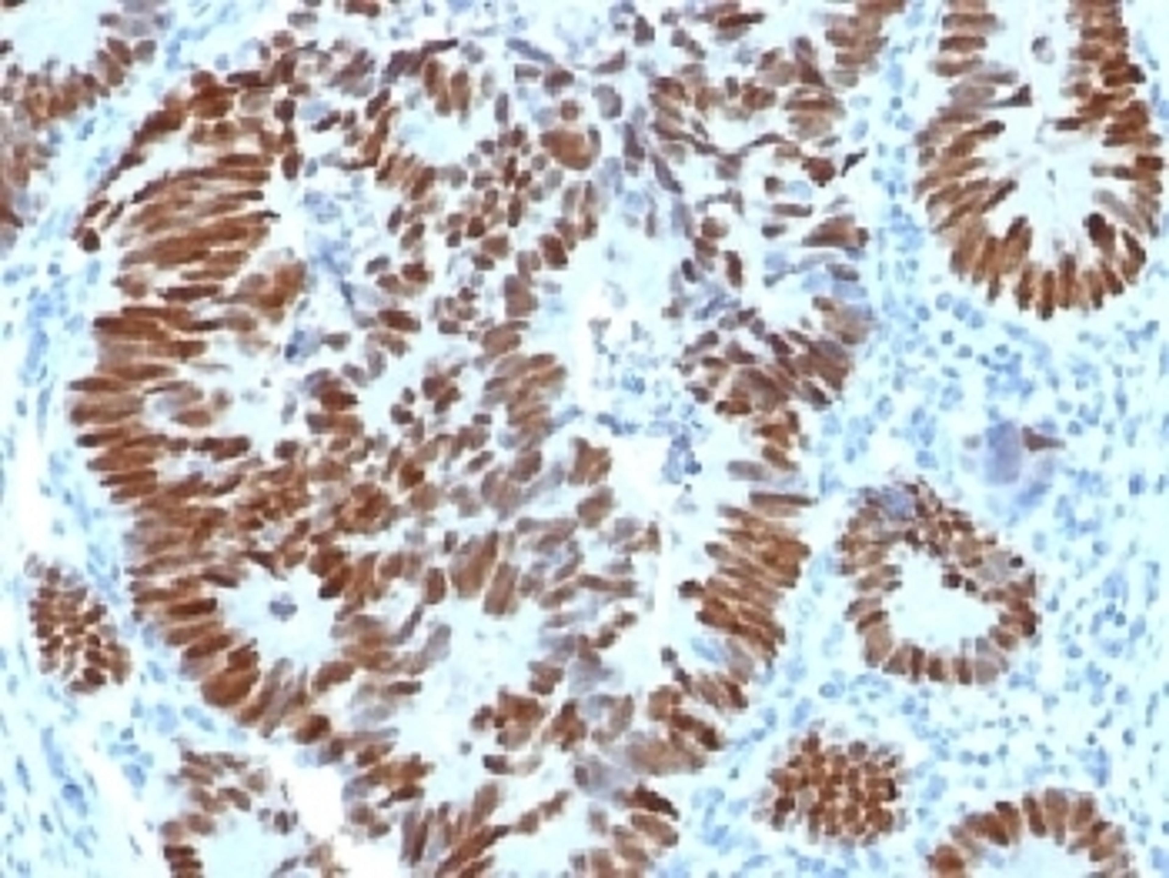 IHC testing of FFPE human colon carcinoma with p53 antibody. Required HIER: boil tissue sections in 10mM citrate buffer, pH 6, for 10-20 min.