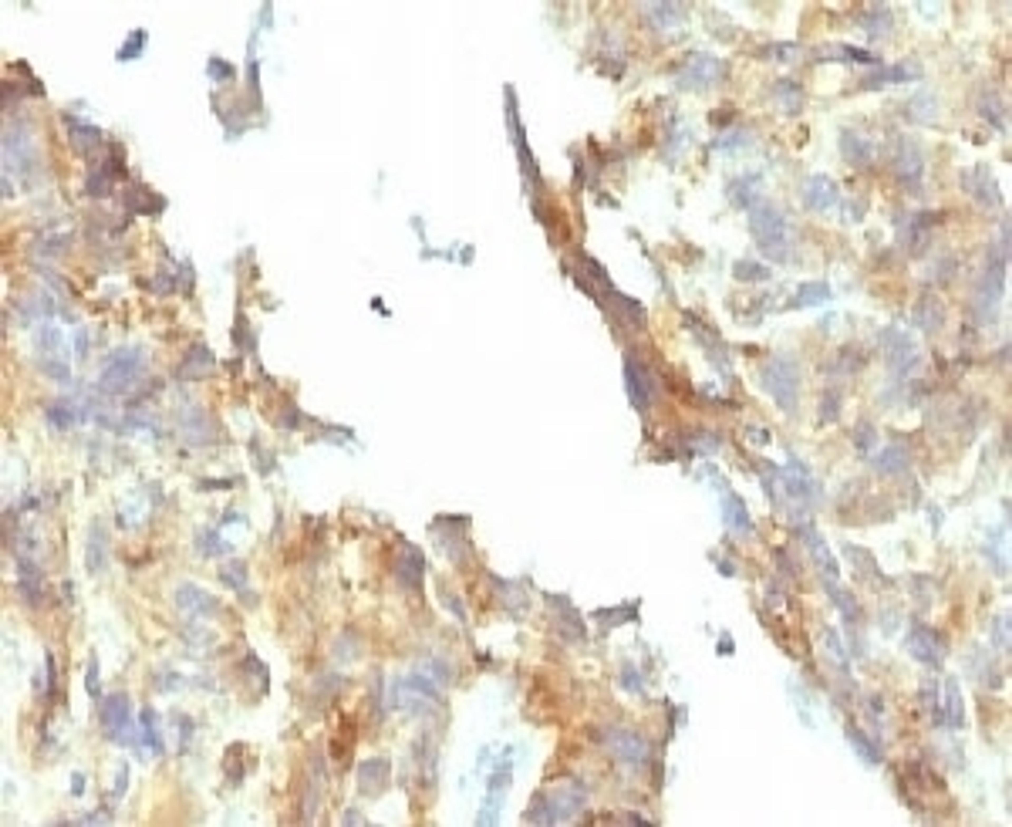 IHC testing of FFPE ovarian carcinoma and Alkaline Phosphatase antibody (KSUL-1). Required HIER: boil tissue sections in 10mM Tris with 1mM EDTA, pH 9, for 10-20 min followed by cooling at RT for 20 min.