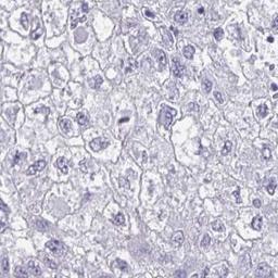 Immunohistochemistry: VSIG10L Antibody [NBP2-32542] - liver cancer