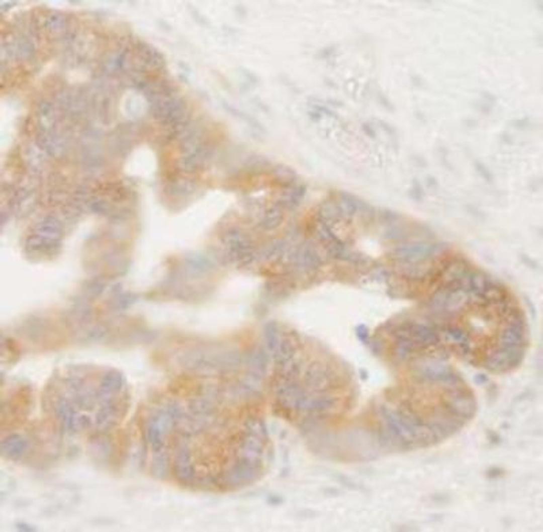 Immunohistochemistry-Paraffin: HP1 alpha Antibody [NB110-40623] - FFPE section of human ovarian tumor.  Affinity purified rabbit anti-BIRC6/Apollon dilution of 1:250.