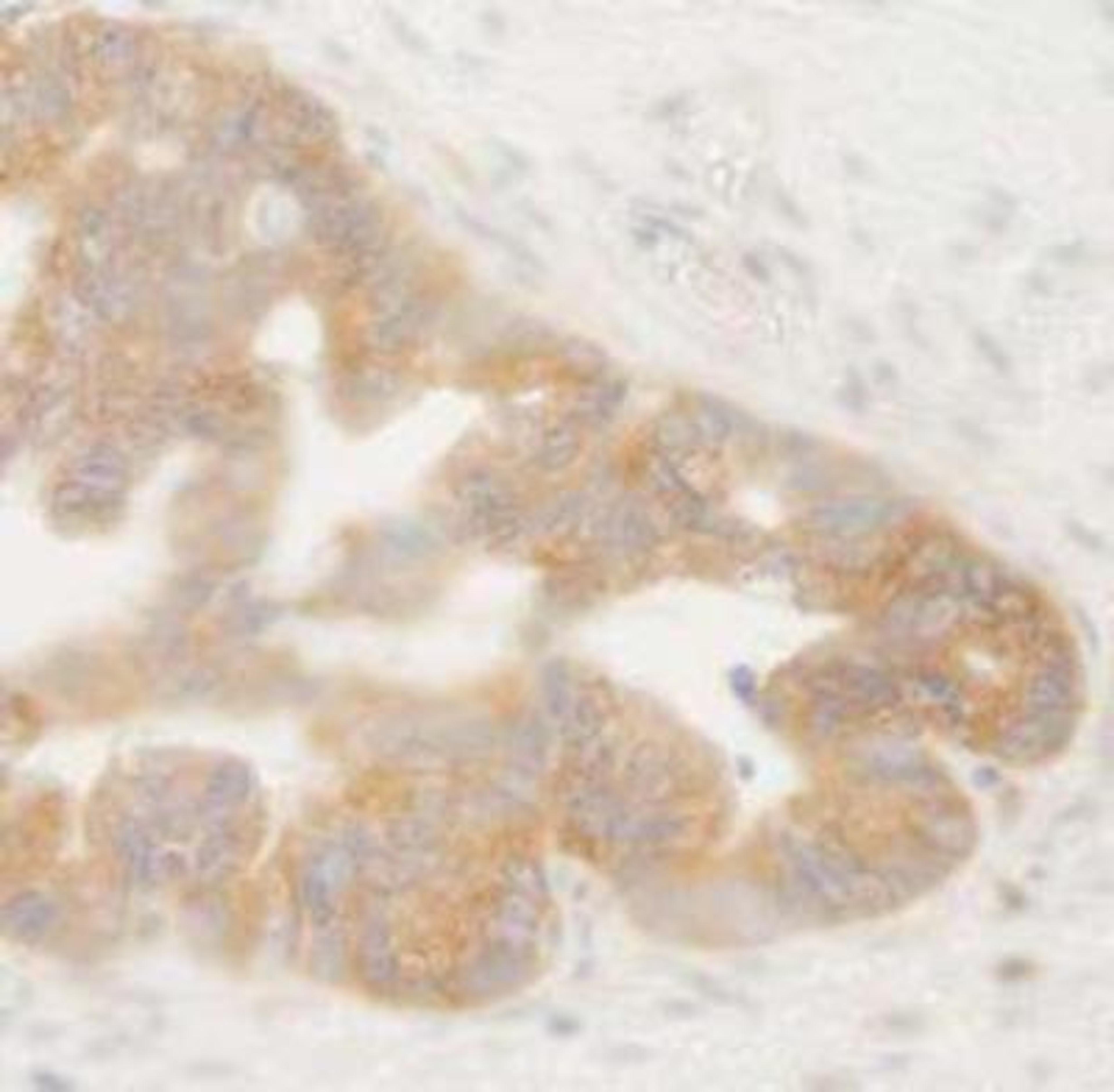 Immunohistochemistry-Paraffin: HP1 alpha Antibody [NB110-40623] - FFPE section of human ovarian tumor.  Affinity purified rabbit anti-BIRC6/Apollon dilution of 1:250.