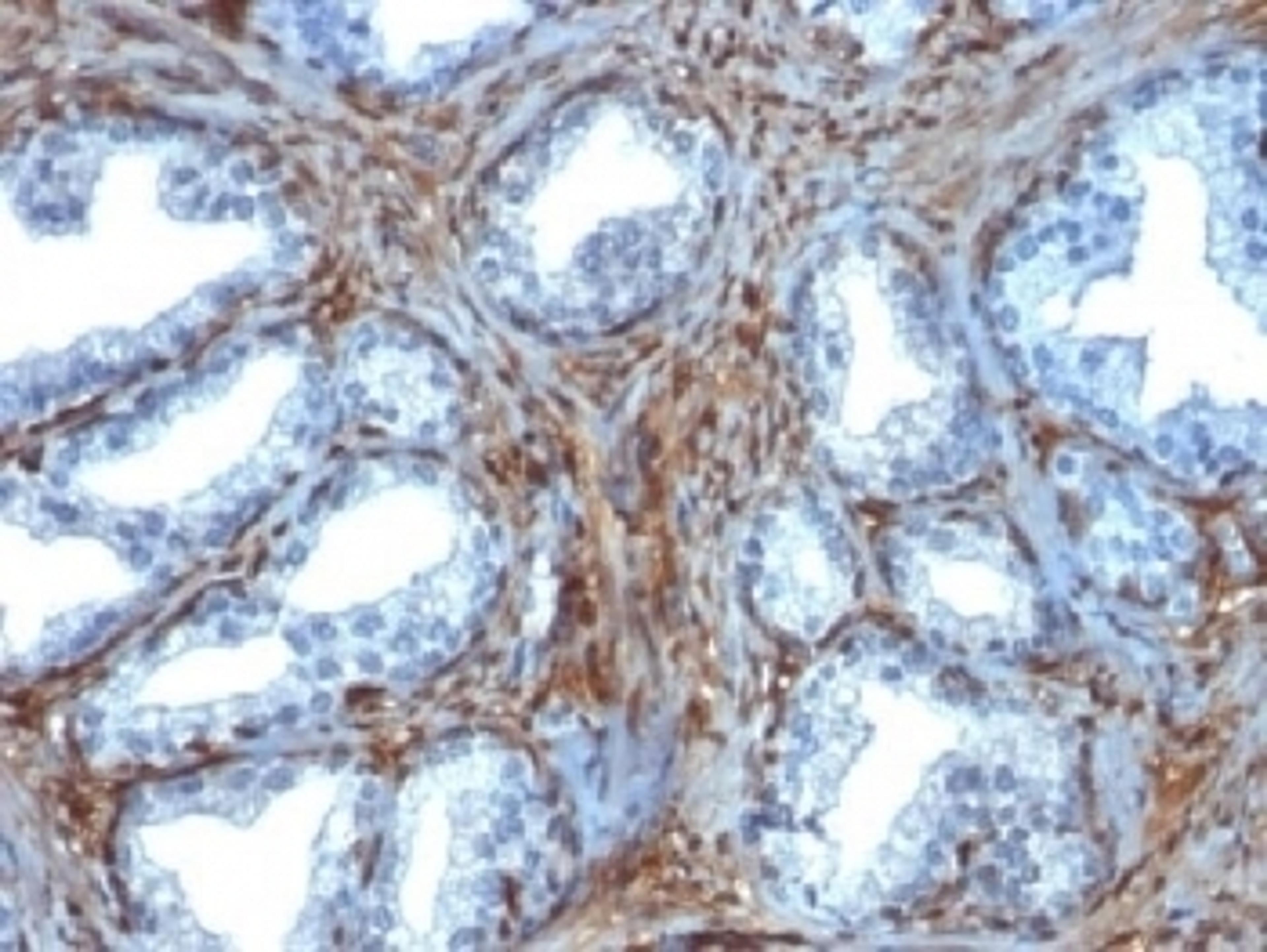 IHC testing of FFPE human prostate carcinoma with Galectin 1 antibody (clone GAL1/1831). Required HIER: boil tissue sections in 10mM citrate buffer, pH 6, for 10-20 min.